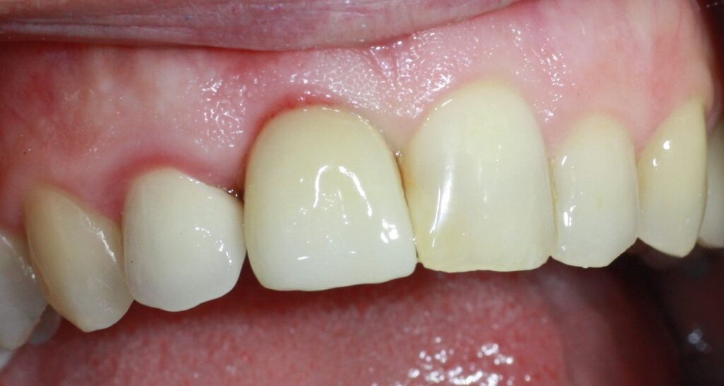Image de la dent N°11 fracturée. Couronne mobile et tuméfaction gingivale.