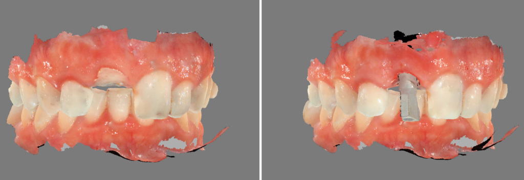 Empreintes optiques de l'implant IDAll.