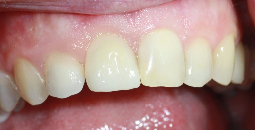 Mise en place de la couronne définitive sur implant transvissée.