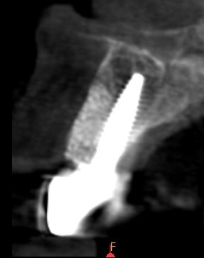 Contrôle radiologique après la pose de la couronne définitive.
