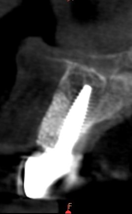 Suivi radiologique à 18 mois.