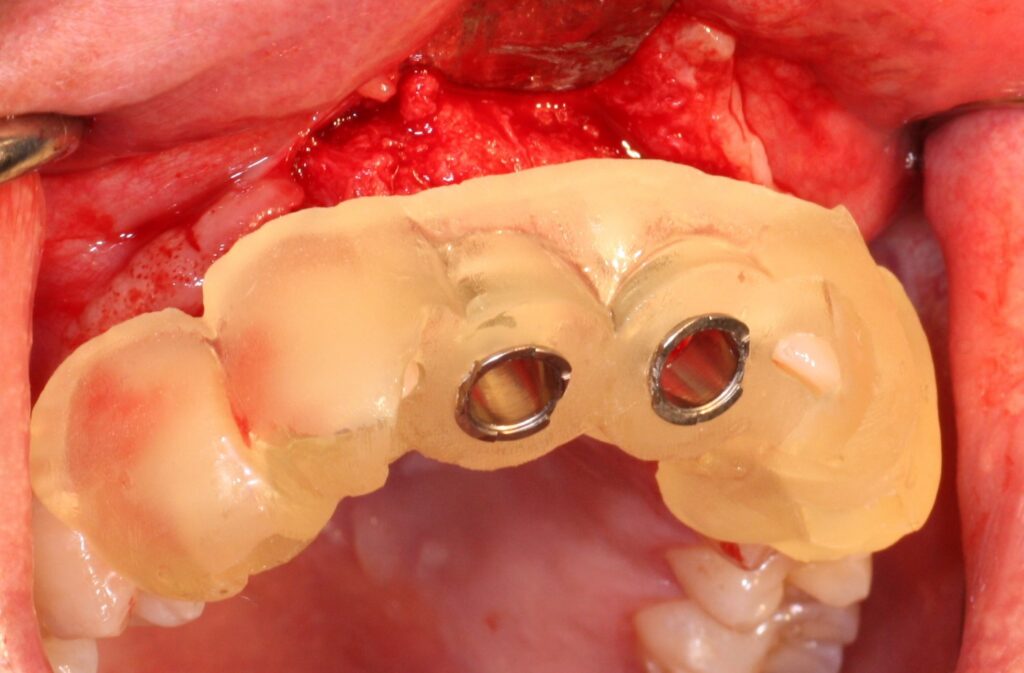 Guide chirurgical en place