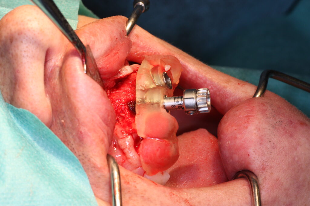 Mise en place de l'implant