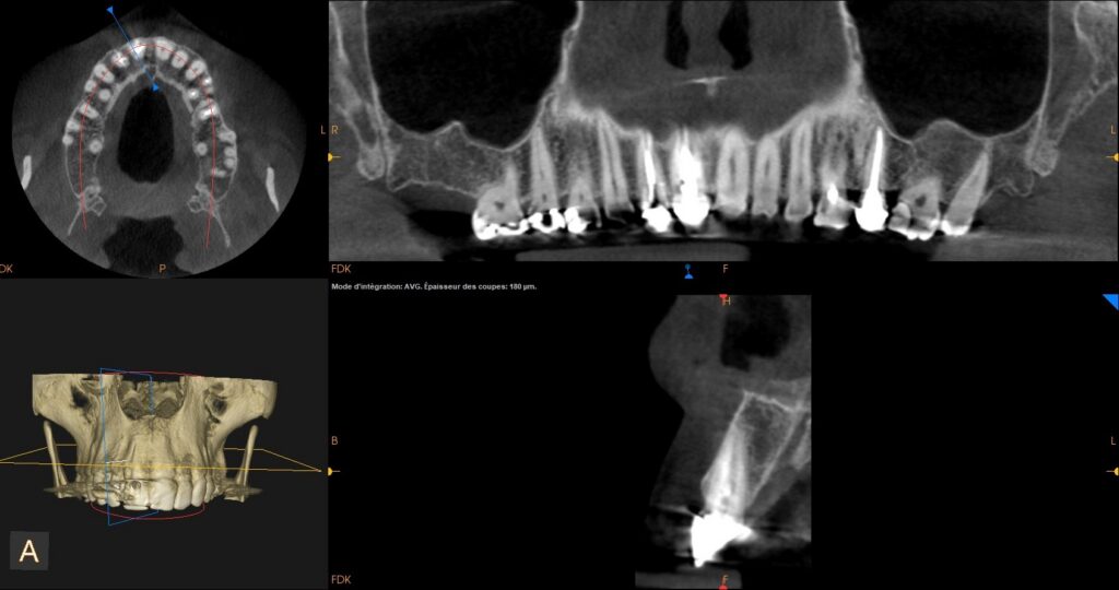 Image radiologique du cône beam pré-opératoire au niveau de la dent N°11 fracturée.