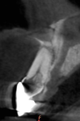 Cone beam pré-opératoire, dent 11