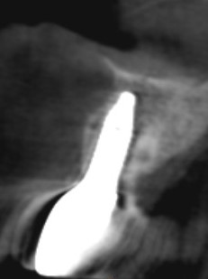 Cone beam en fin de traitement, couronne définitive en place, dent 11
