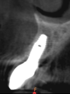 Cone beam en fin de traitement, couronne définitive en place, dent 21