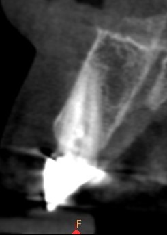 Vue radiologique du cône beam au niveau de la dent N°11 fracturée.