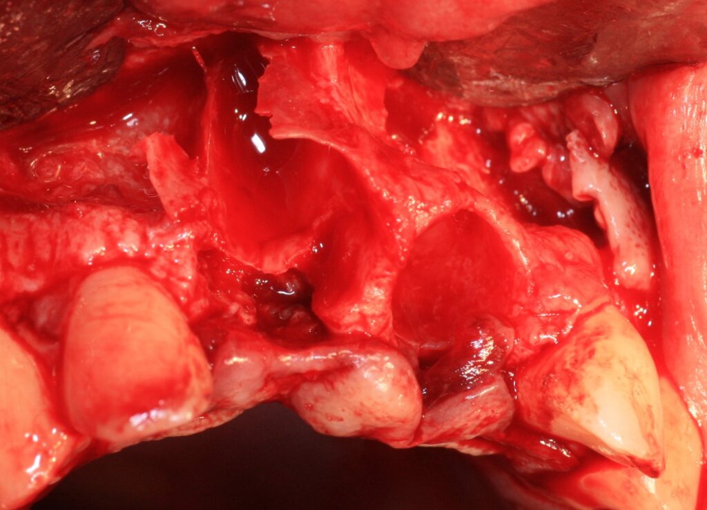 Site chirurgical après extraction