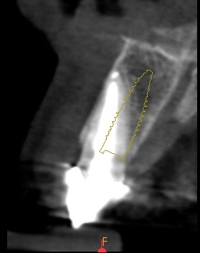 Planification implantaire radiologique au niveau de la dent N°11.