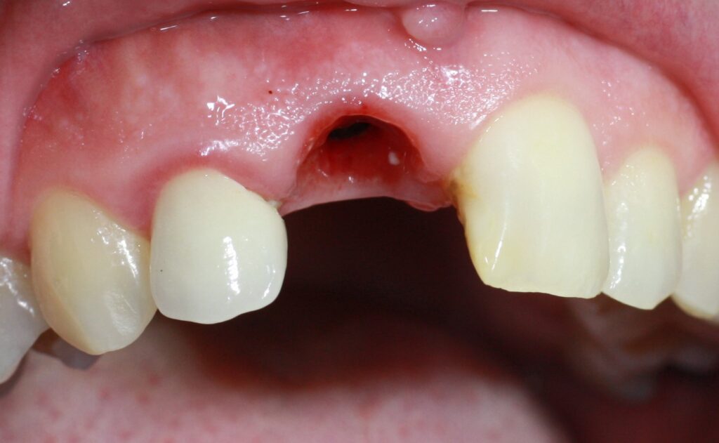 Mise en place de l'implant post-extractionnel au niveau de la dent extraite N°11.