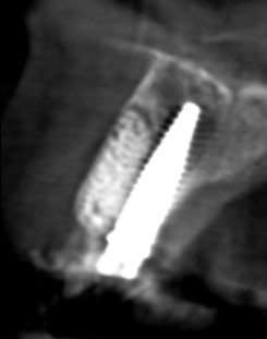 Contrôle radiologique de l'implant en post-opératoire.