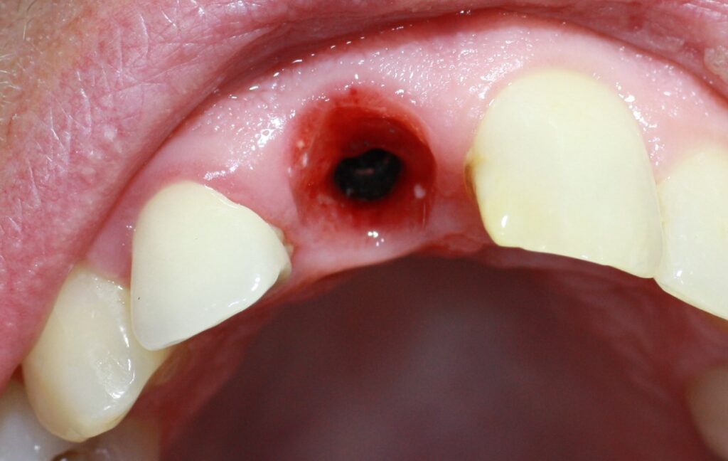 Vue occlusale de l'implant au stade du contrôle de l'ostéointégration.