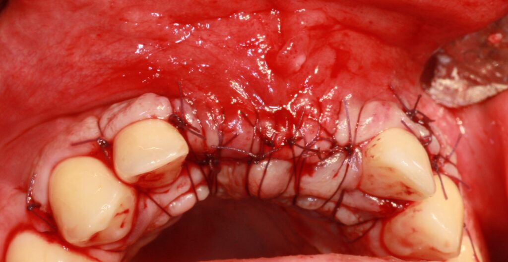 Sutures