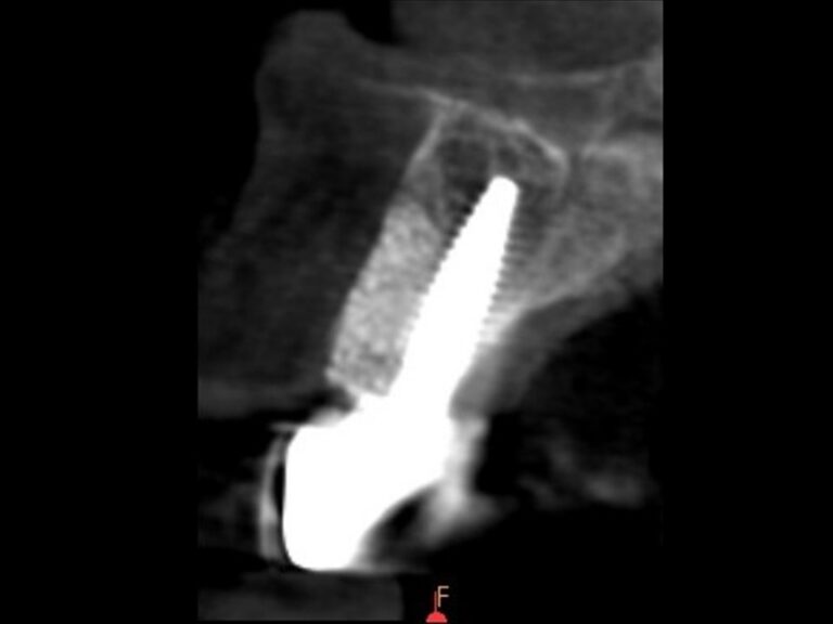 Cone beam de l'implant en 11 avec couronne définitive