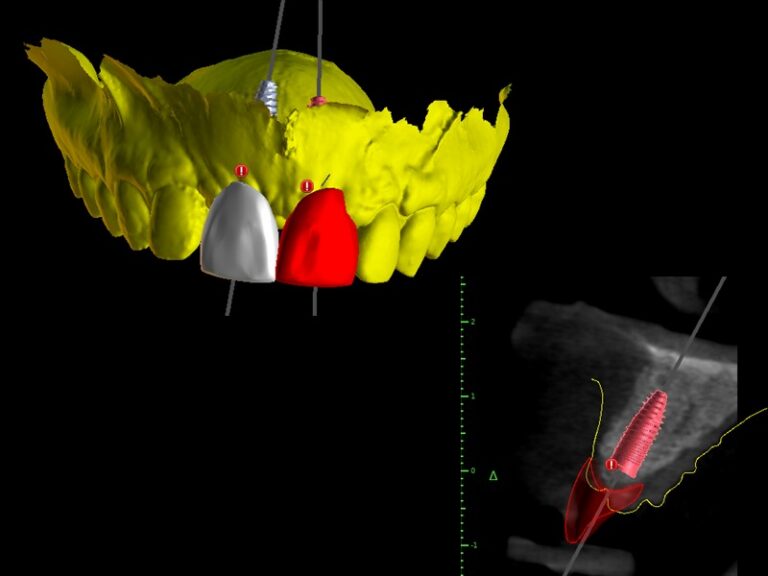 Planification implantaire en chirurgie guidée de 11 et 21