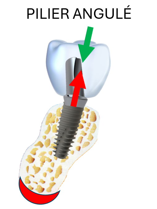 Implant posé dans le couloir osseux : la composante verticale d'une force latérale atténue la composante transverse
