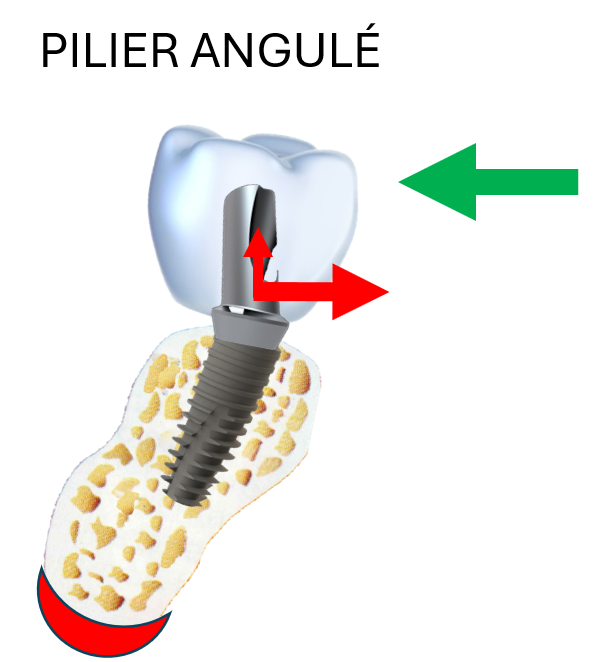 Implant posé dans le couloir osseux : les contraintes d'une force occlusale s'opposent à celle-ci sans cisaillement