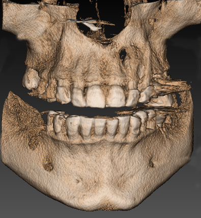 Vue 3D, examen cone-beam
