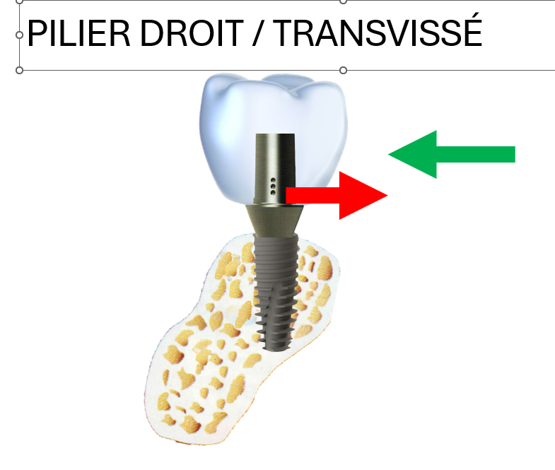 Implant posé perpendiculairement à un plan horizontal : les contraintes engendrées par une force latérale sont uniquement transverses