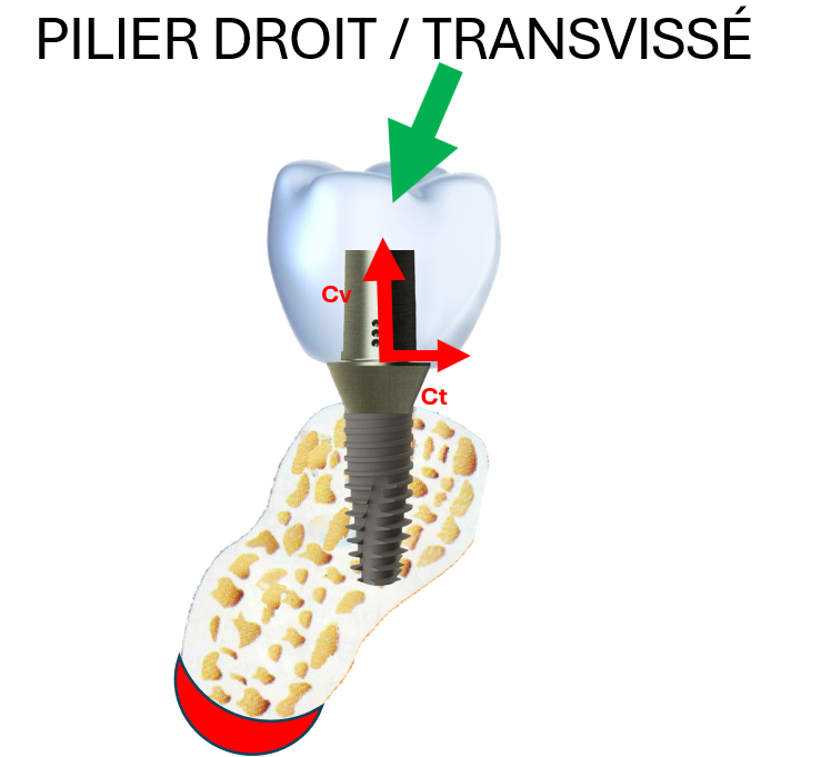 Implant posé perpendiculairement à un plan horizontal : décomposition des contraintes d'une force occlusale, verticale et transverse