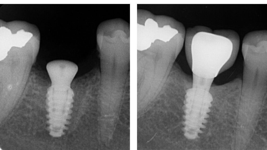 Cas clinique — contrôle radiographique à 5 ans