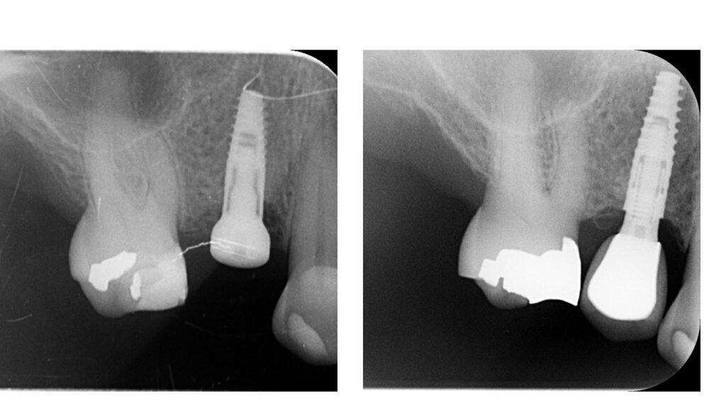 Cas clinique — contrôle radiographique à 5 ans