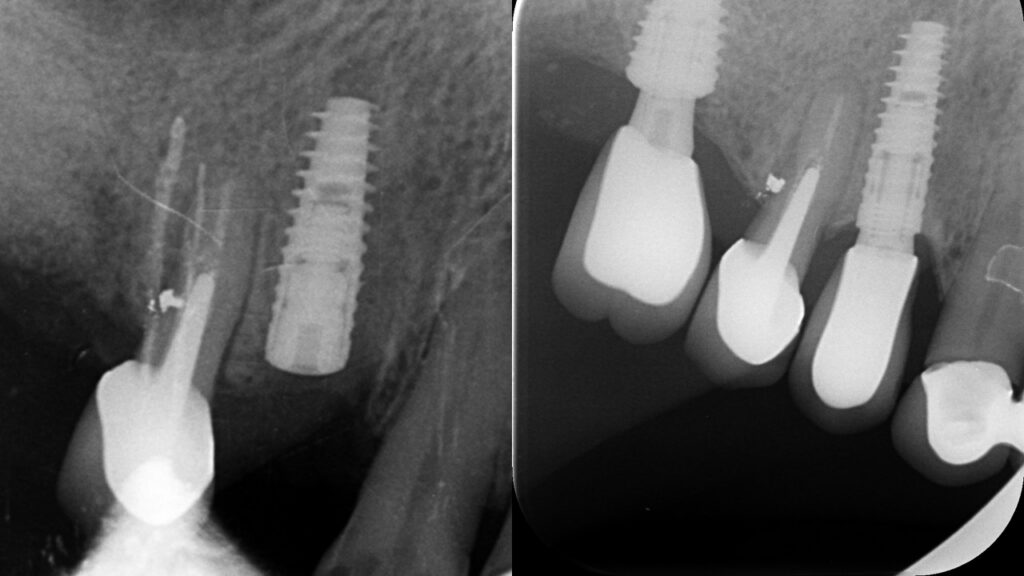 Cas clinique — contrôle radiographique à 5 ans
