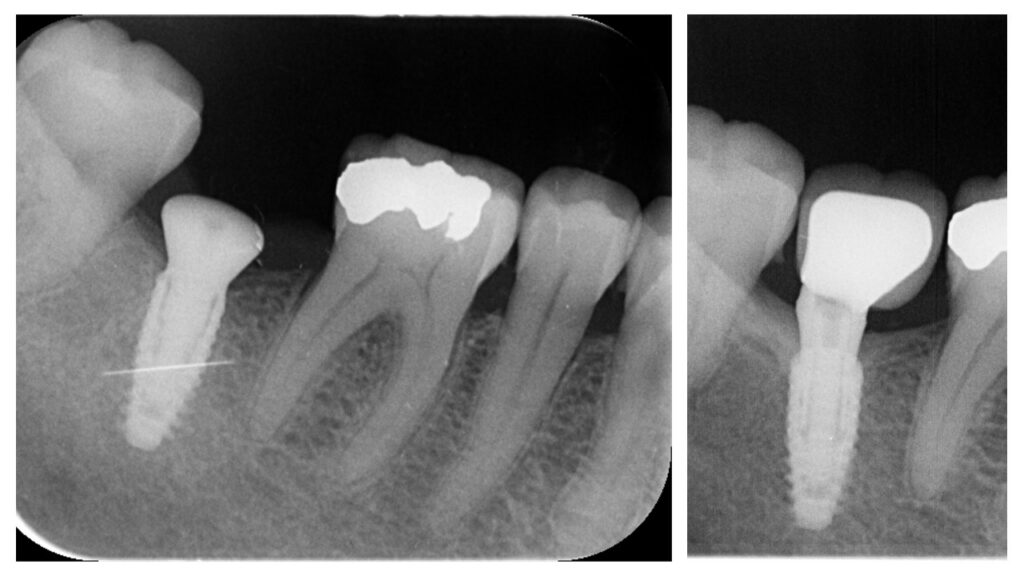 Cas clinique — contrôle radiographique à 5 ans