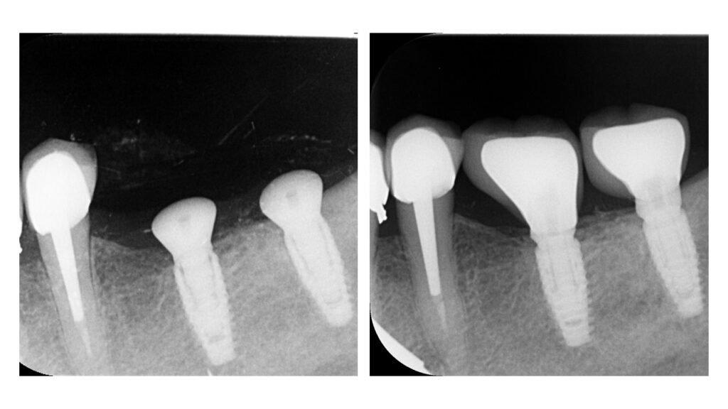 Cas clinique — contrôle radiographique à 5 ans