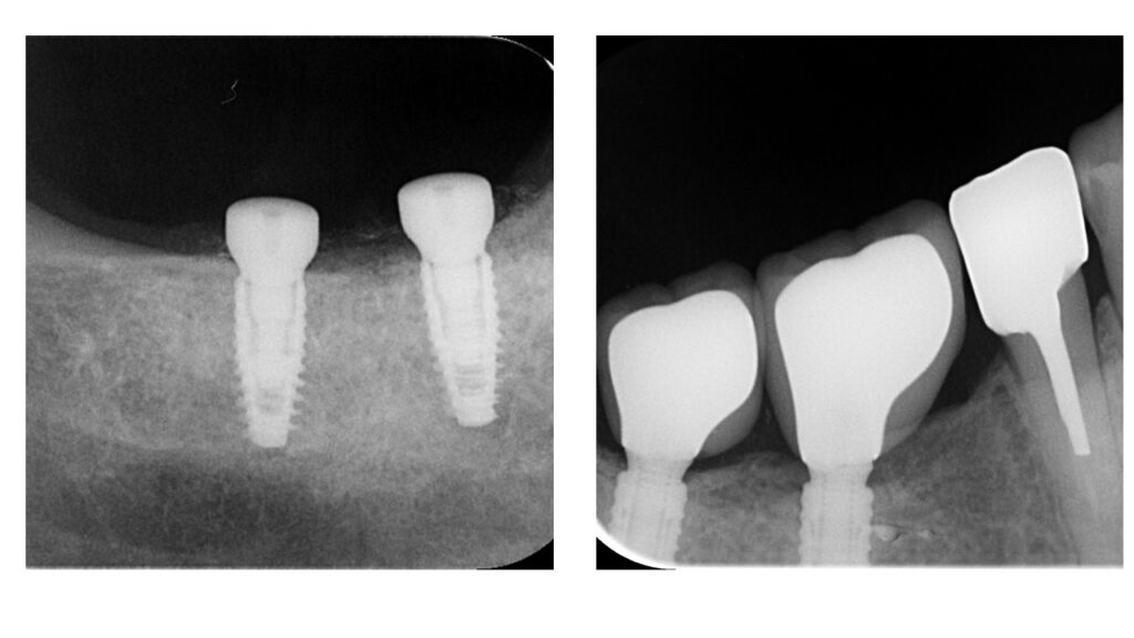 Cas clinique — contrôle radiographique à 5 ans