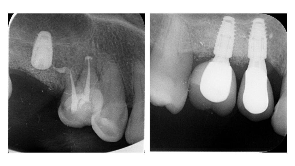 Cas clinique — contrôle radiographique à 5 ans